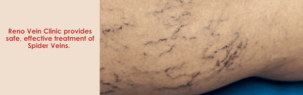 Spider veins or telangiectasia