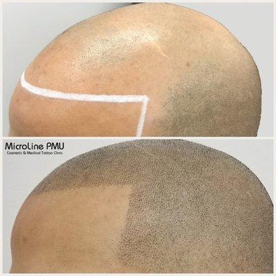 MicroScalp- Scalp Micropigmentation