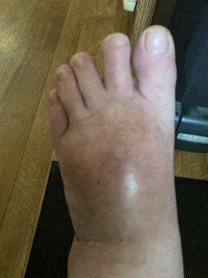 My brothers swollen feet