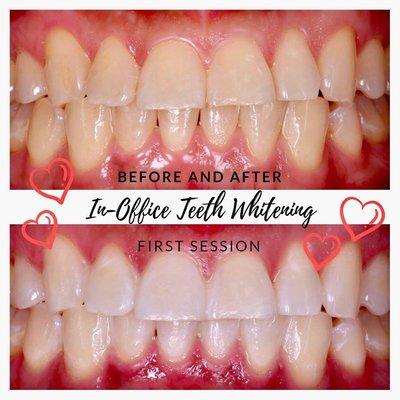 Zoom In-Office Teeth Whitening