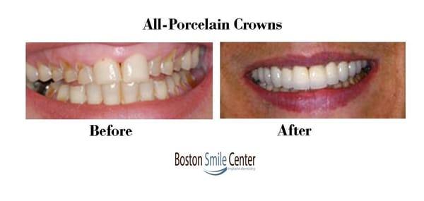 All - Porcelain Crowns