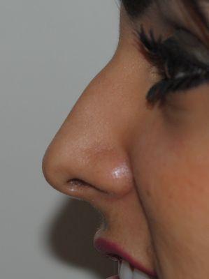 Rhinoplasty (nose job)
 Before