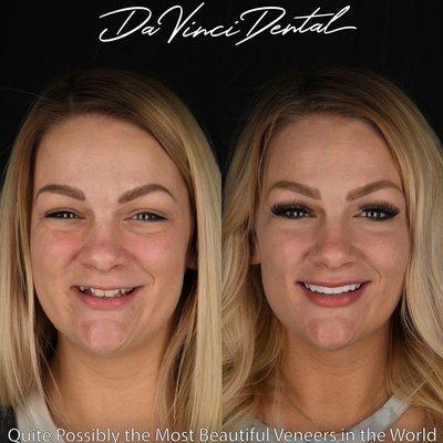 Porcelain Veneers by Dr. Keller