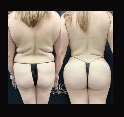 Lipo360+, fat transfer to buttocks