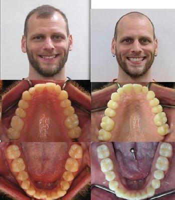 Less than 18 months of treatment with Invisalign!