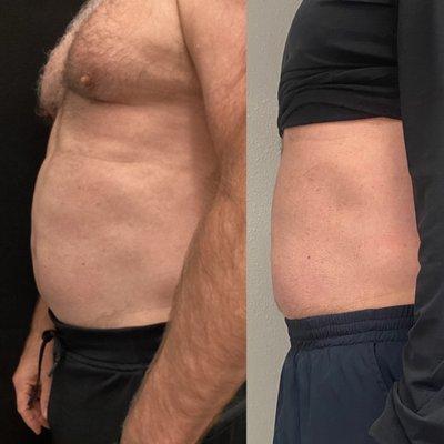 One treatment of trusculpt ID fat melting 3 months post treatment.