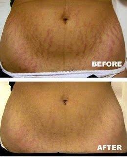 Stretch Mark Camouflage Treatment