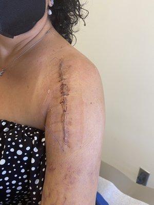 Stitches were removed and ready for PT!