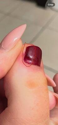 Infection and uncured polish