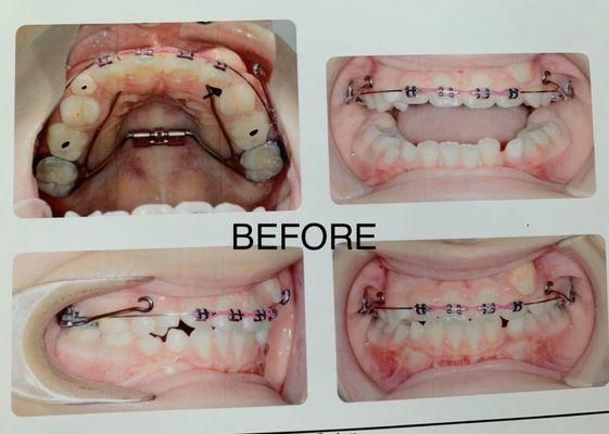 Left incisor was erupting in the gums because of overcrowding. This was another orthodontist's work, which Dr. Chang fixed.