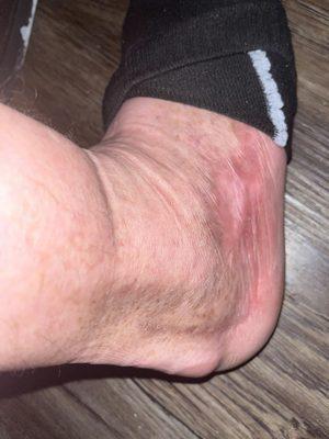 Current pic of ankle. Maybe if not rushed and properly treated could have been healed already