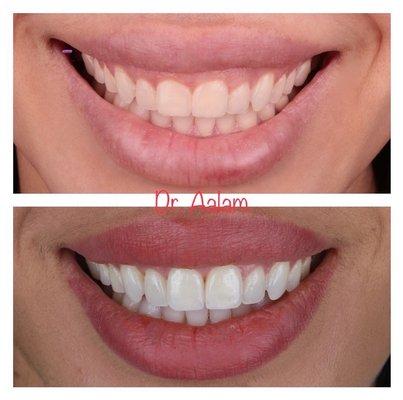 Close up view of the smile improvement. Before and after crown lengthening