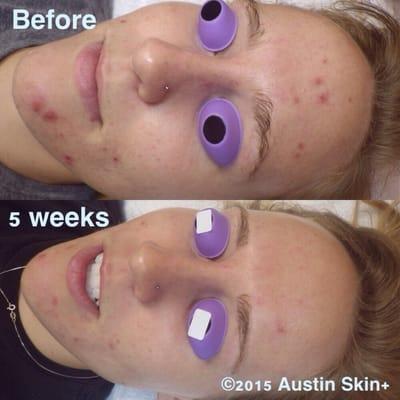 5 week check in! 4 acne peels combined with at home products. We are on our way to clear skin:)