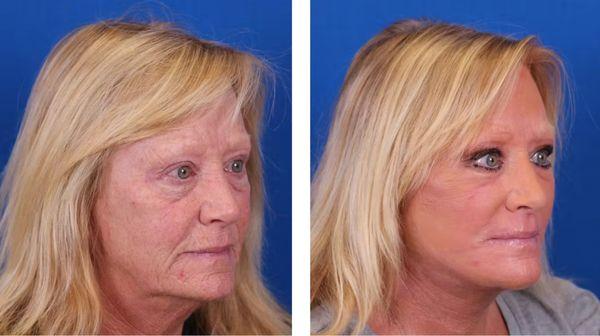 Facelift before and after