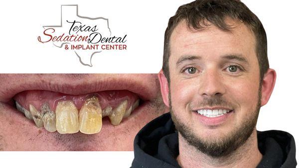 Our Teeth in 24 Hours Procedure