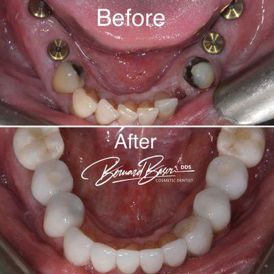 Restoring lower teeth with porcelain veneers and implants.