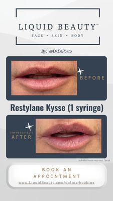 Restylane Kysse lip filler augmentation at Liquid Beauty Temecula by Dr. DePorto MD.