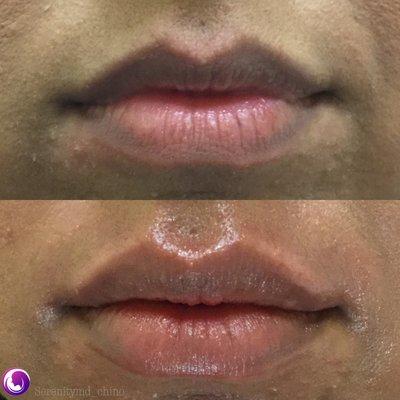 Juvederm Lip filler.