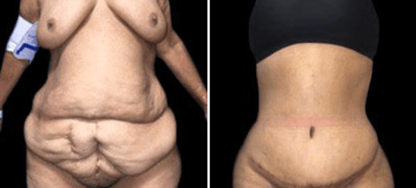 Tummy Tuck/Body Lift Before & After