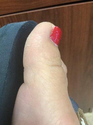 Horrible pedicure photo