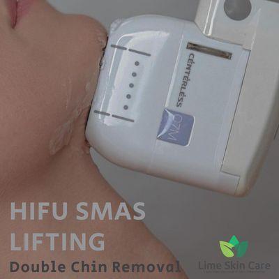 Double Chin removal with Utims Smas Lifting