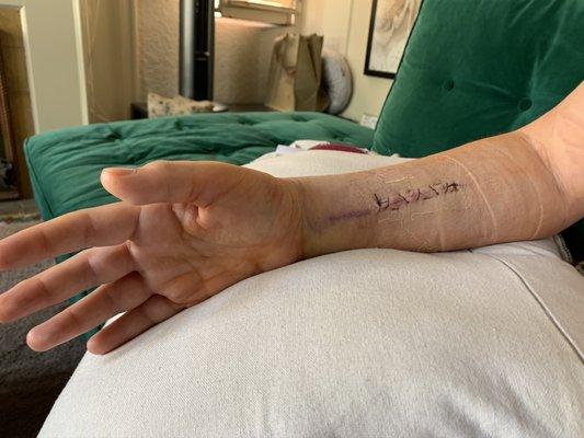 My sad arm one week after surgery.