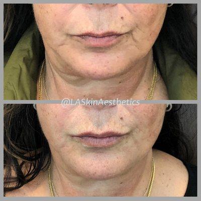 Jawline rejuvenation: dermal fillers can mask jowling and saggy skin