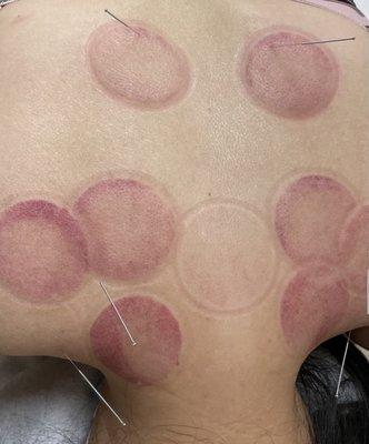 Cupping followed by acupuncture.