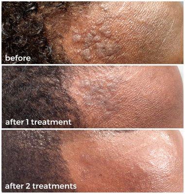 Progression of keloid scar revision. Service performed at Ashtoria by Valerie Monismith, RN.