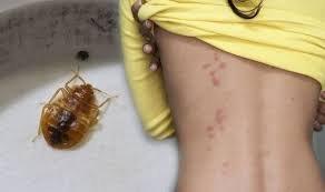 Bed Bug Bites