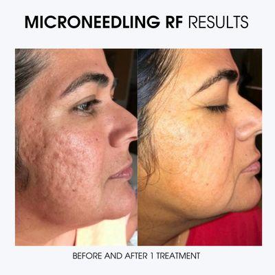 Results after one Microneedling RF Virtue treatment