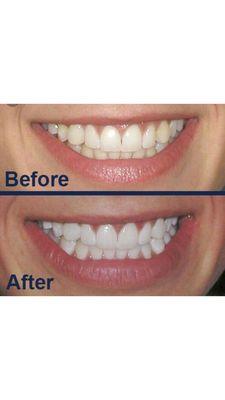 Whitening kit