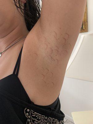 Burns from laser hair removal