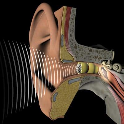 Lyric Hearing Device