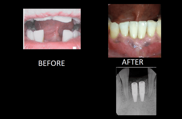 Dental implants can be used to replace missing teeth.