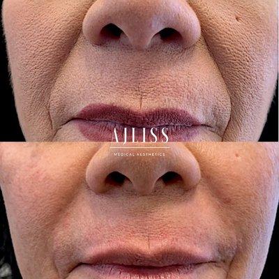 Dermal filler is a great way to reduce the appearance of the nasolabial folds (nose to mouth lines).