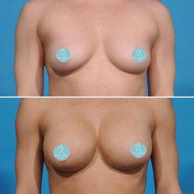 Breast Augmentation