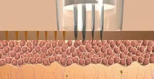 the tiny holes that the micro-needling procedure creates aides in the natural production of collagen