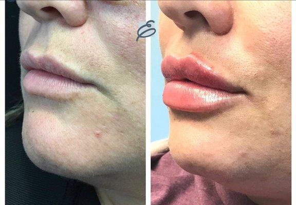 Lip filler at Erasable Inc.