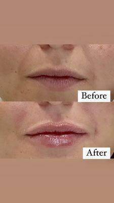 Natural lip fillers