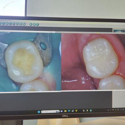 This old cavity was cleaned out and looks good as new!