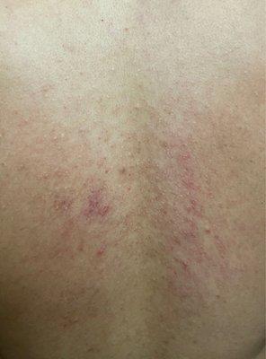 Back rash after massage