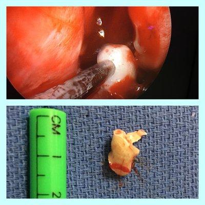 Tooth removed from the sinuses which was causing years of facial pain and headaches.