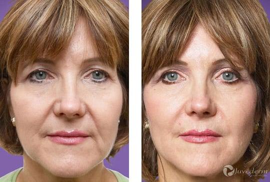 Juvederm Before and After