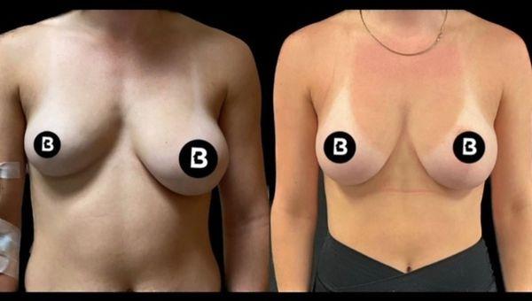 Breast aug for symmetry #plasticsurgery #buffalo #drdawli