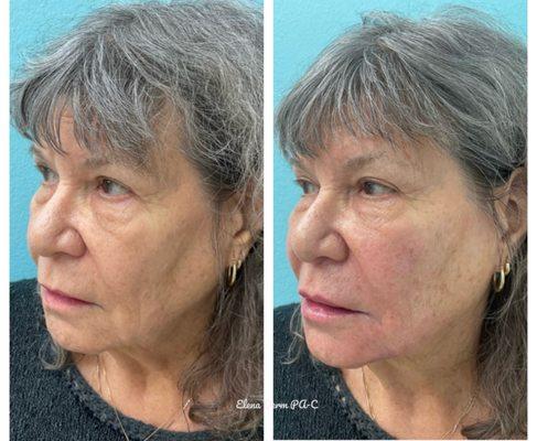 Elena Novak PA-C used RHA and Versa to transform this patients Cheeks, Nasolabial Folds, Marionette Lines, and Lips.