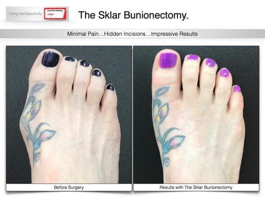 We don't compromise beauty to correct the function of your feet! Visit www.footfirst.com for info about our unique bunion procedure.