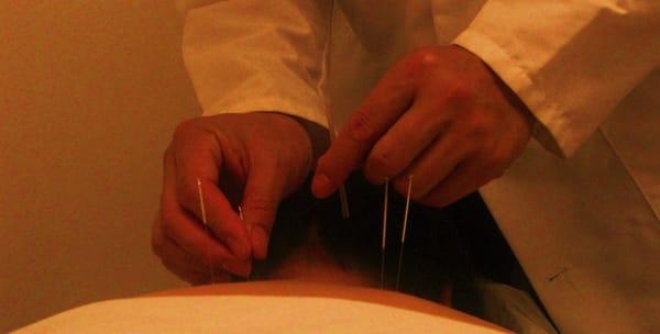 Dr. Shi performing acupuncture