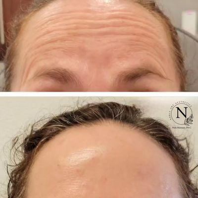 Botox Treatment Before and After