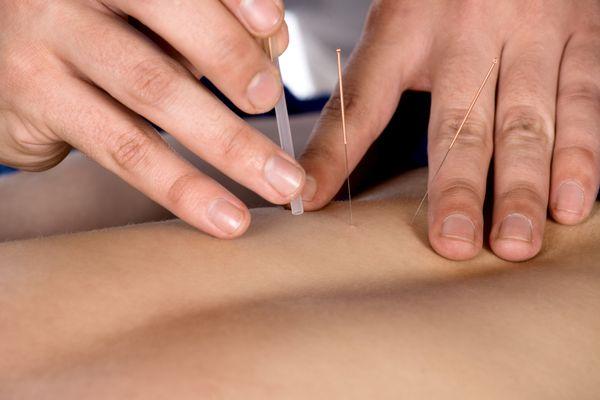 Dry Needling Therapy